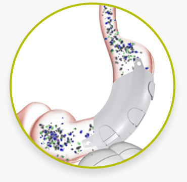 ReShape Vest – Nex-gen Treatment for Obesity